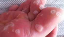 去除鸡眼视频,跟随视频教程学除法